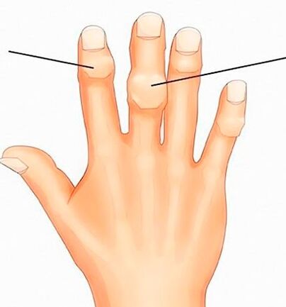 Heberdenovi in ​​Bouchardovi vozli na interfalangealnih sklepih z artrozo