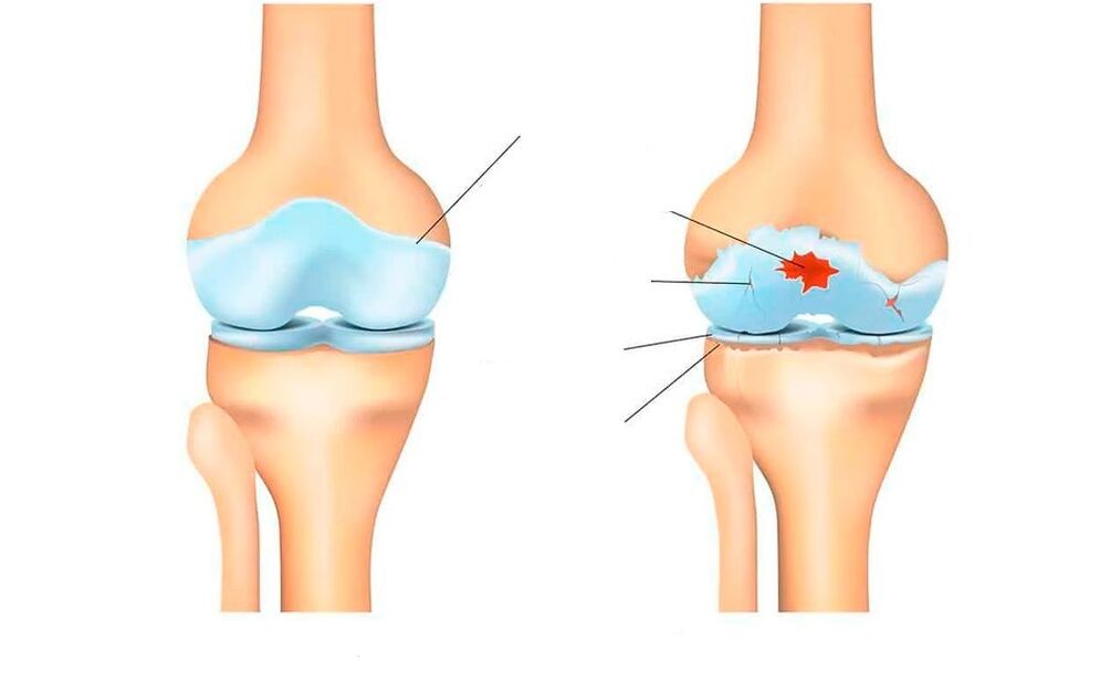 zdrav sklep in z artrozo