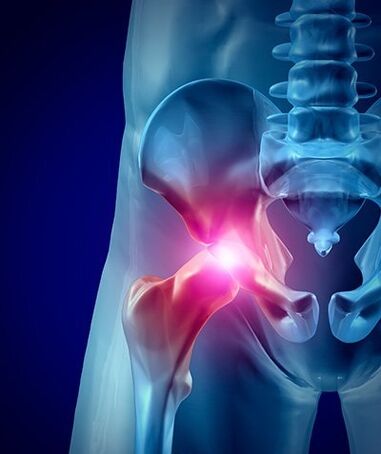 fotografija bolečine v kolku 1