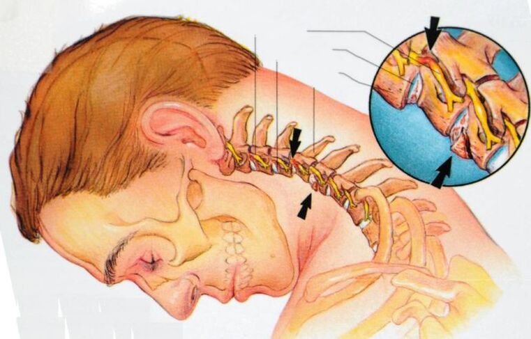 simptomi cervikalne osteohondroze