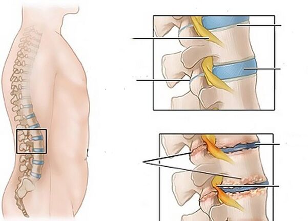 spremembe diskov zaradi osteohondroze